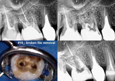 Leczenie kanałowe pod mikroskopem zęba 16